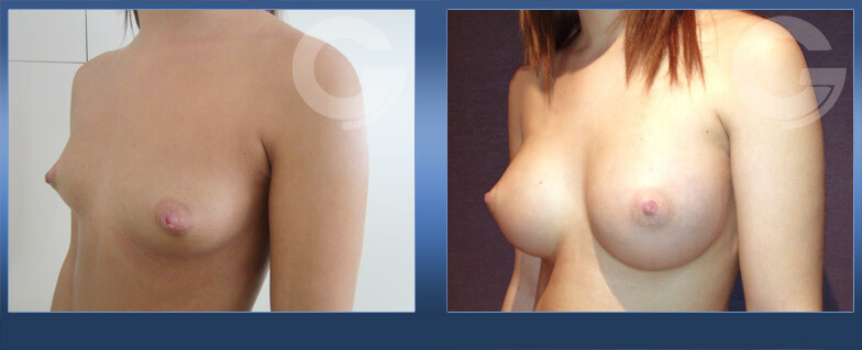 Before and After Result